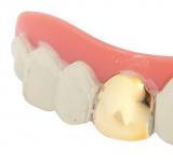 Dentier avec dent en or